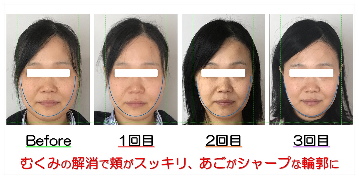 滋賀守山市 小顔だけでなく歪み エラ むくみ 輪郭の矯正に自信あり