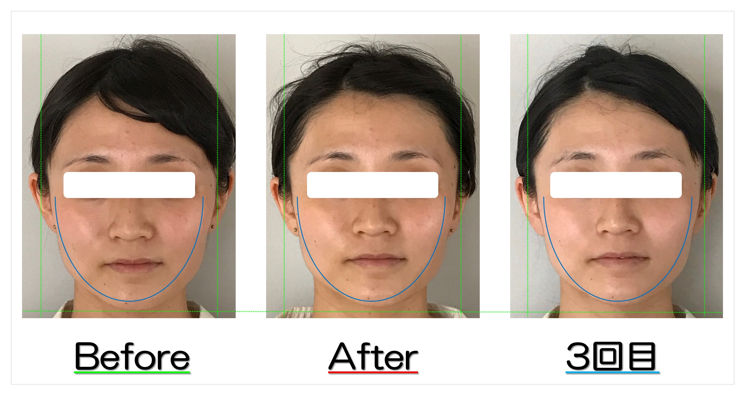 輪郭の左右差と歪みが改善 滋賀守山市の小顔歪み