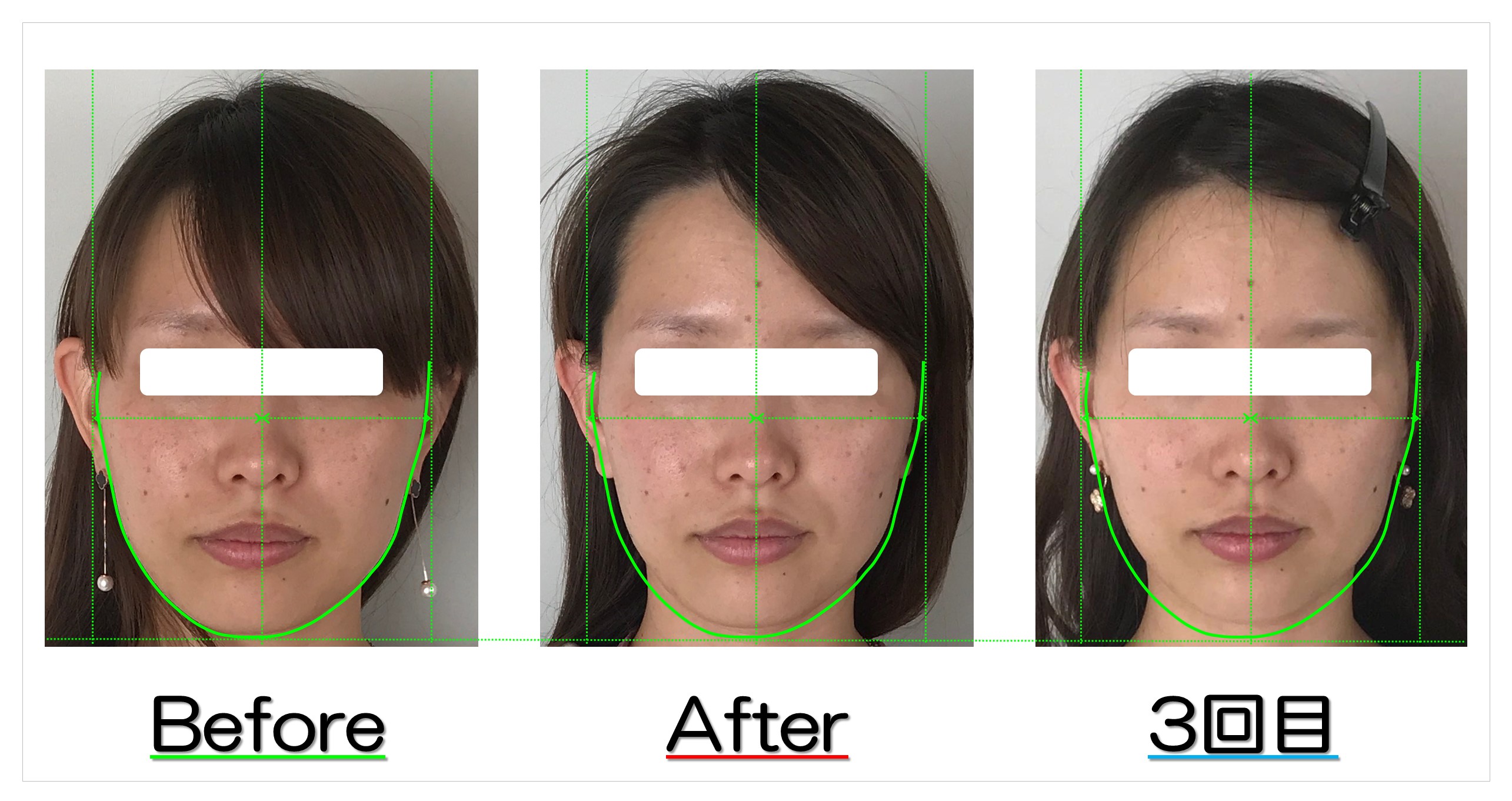 アゴの長さが短く歪みも改善 滋賀守山市の小顔