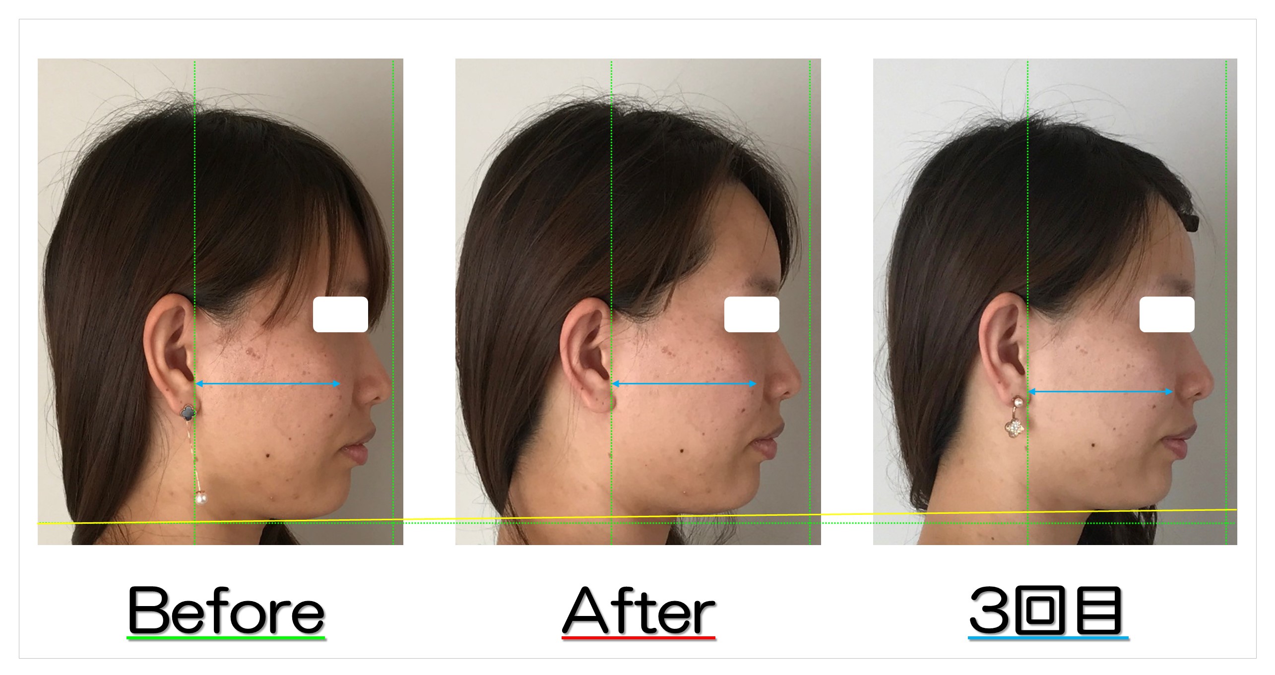 アゴの長さが短く歪みも改善 滋賀守山市の小顔