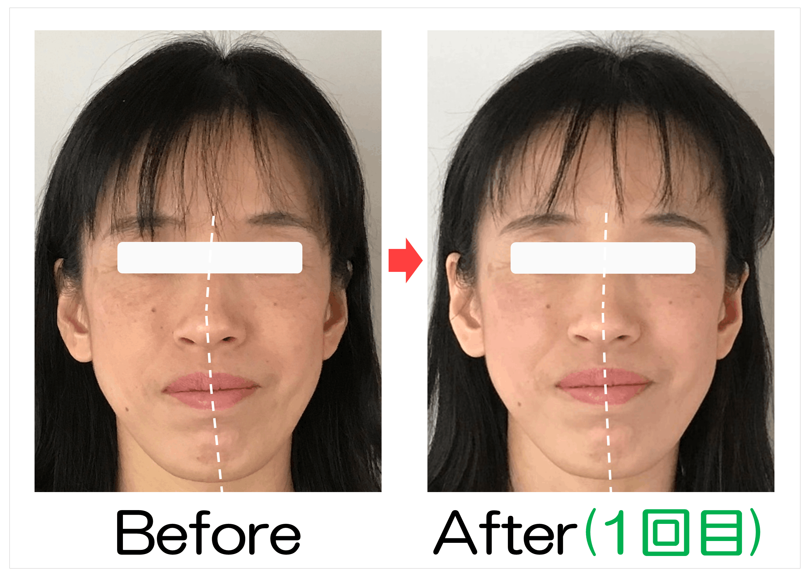 鼻筋からあごの位置のBefore・After（1回目）比較