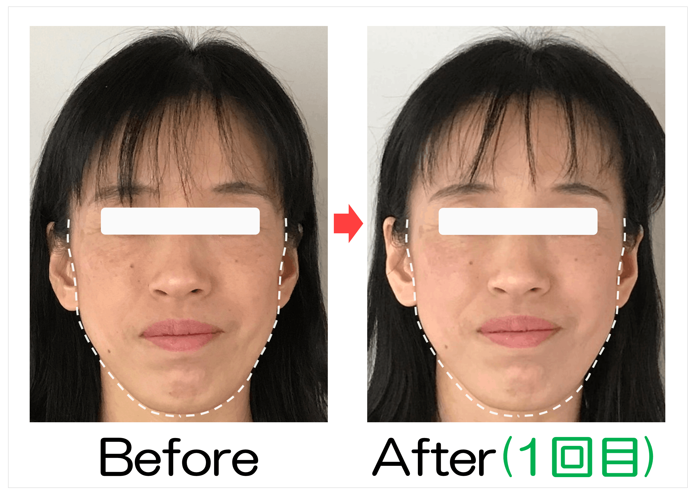 フェイスラインと輪郭のBefore・After（1回目）比較