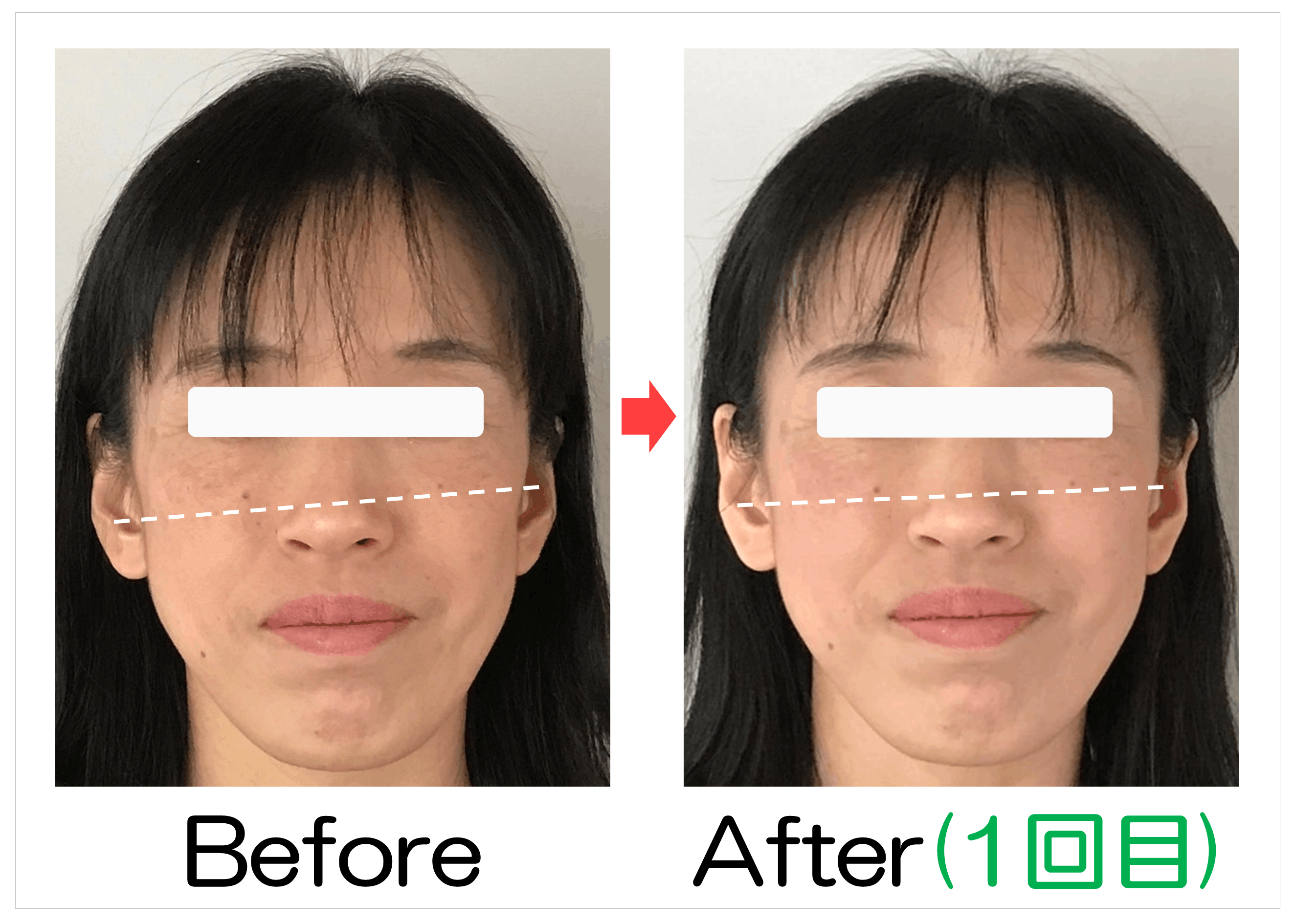 左右の頬の高さのBefore・After（1回目）比較