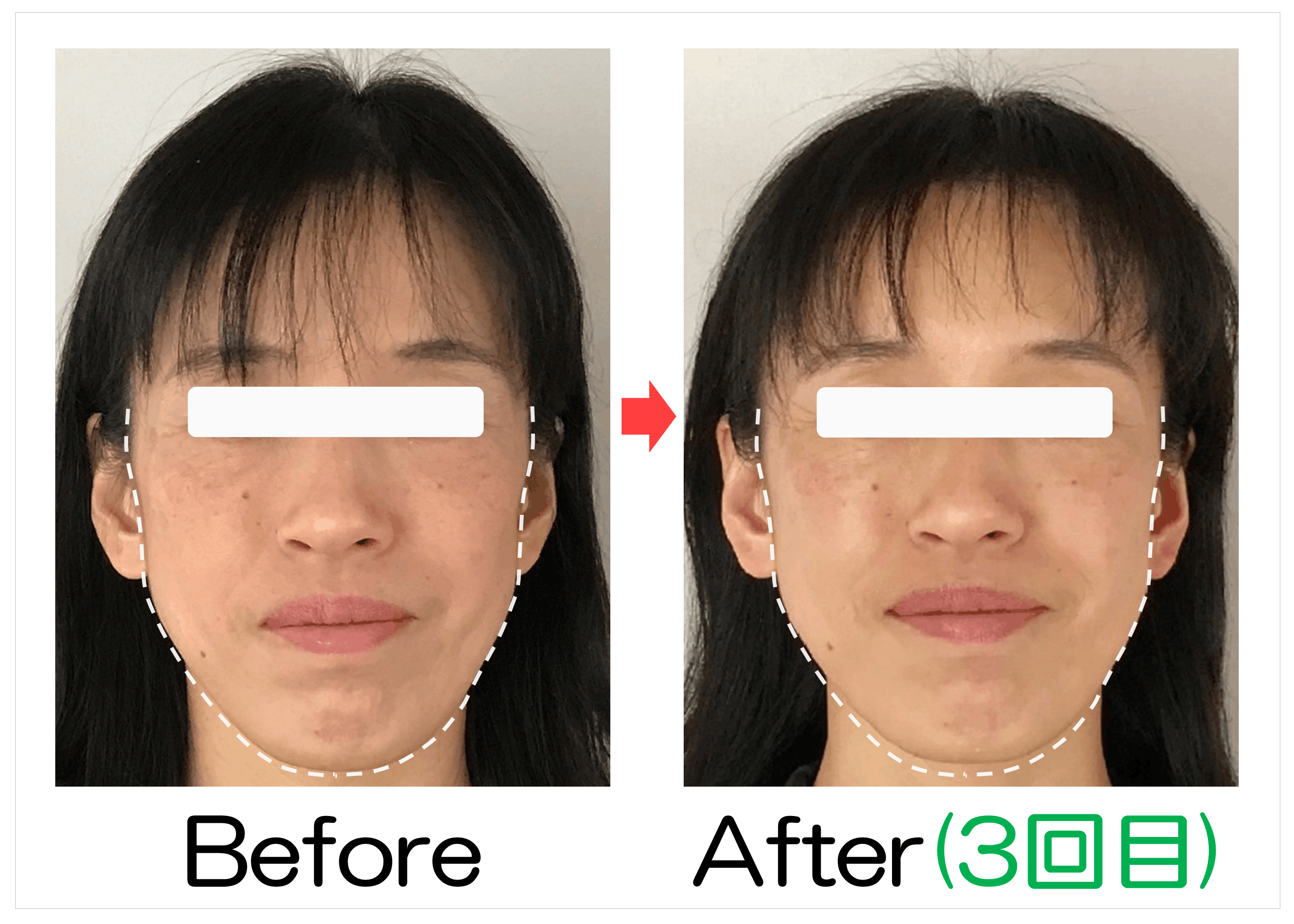 フェイスラインと輪郭のBefore・After（3回目）比較