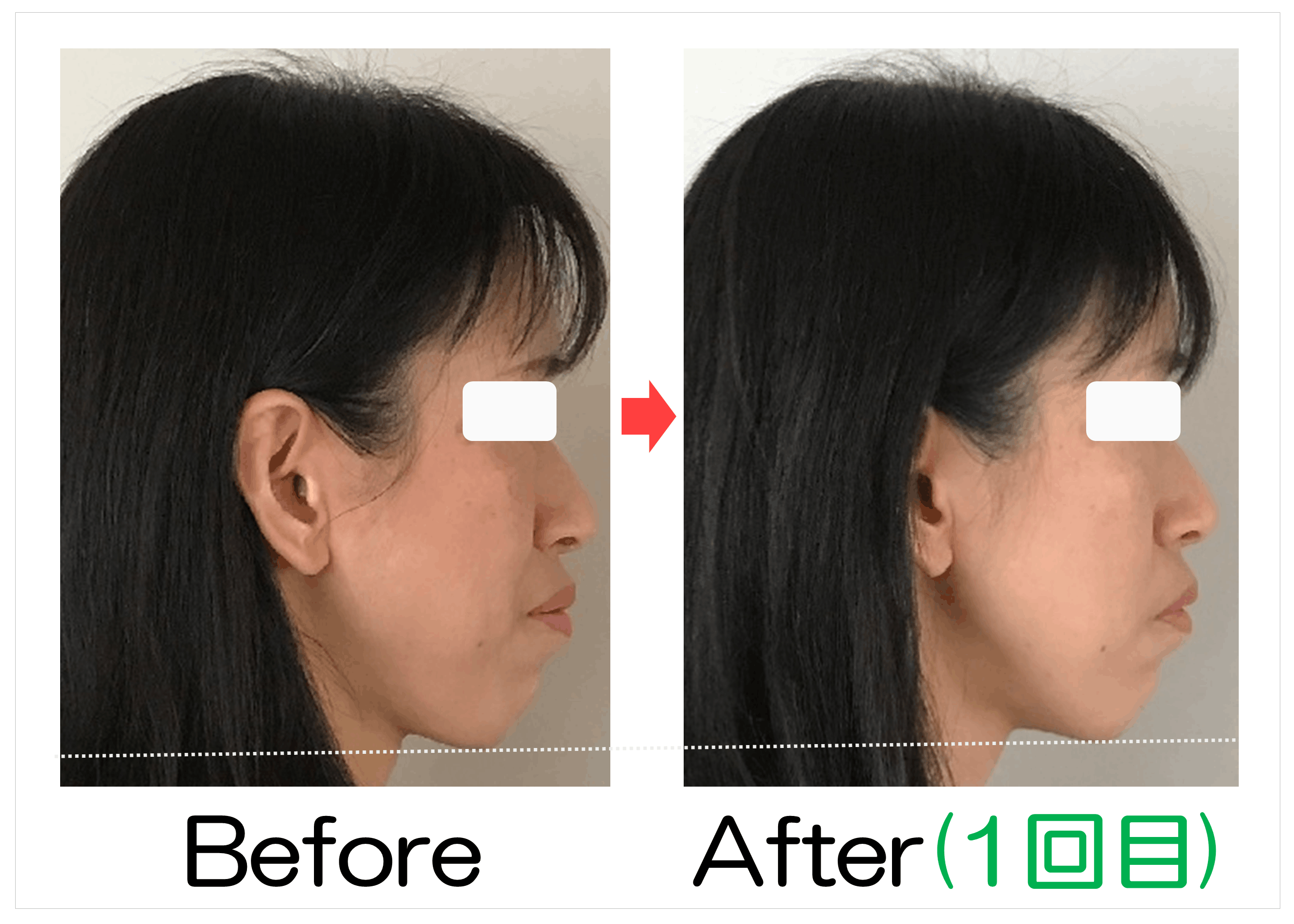 横顔とフェイスラインのBefore・After（1回目）比較