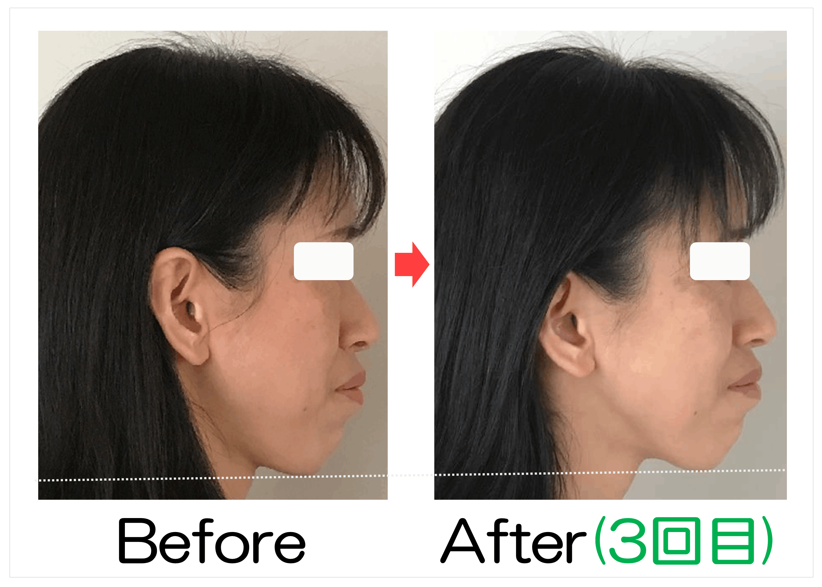 横顔とフェイスラインのBefore・After（3回目）比較