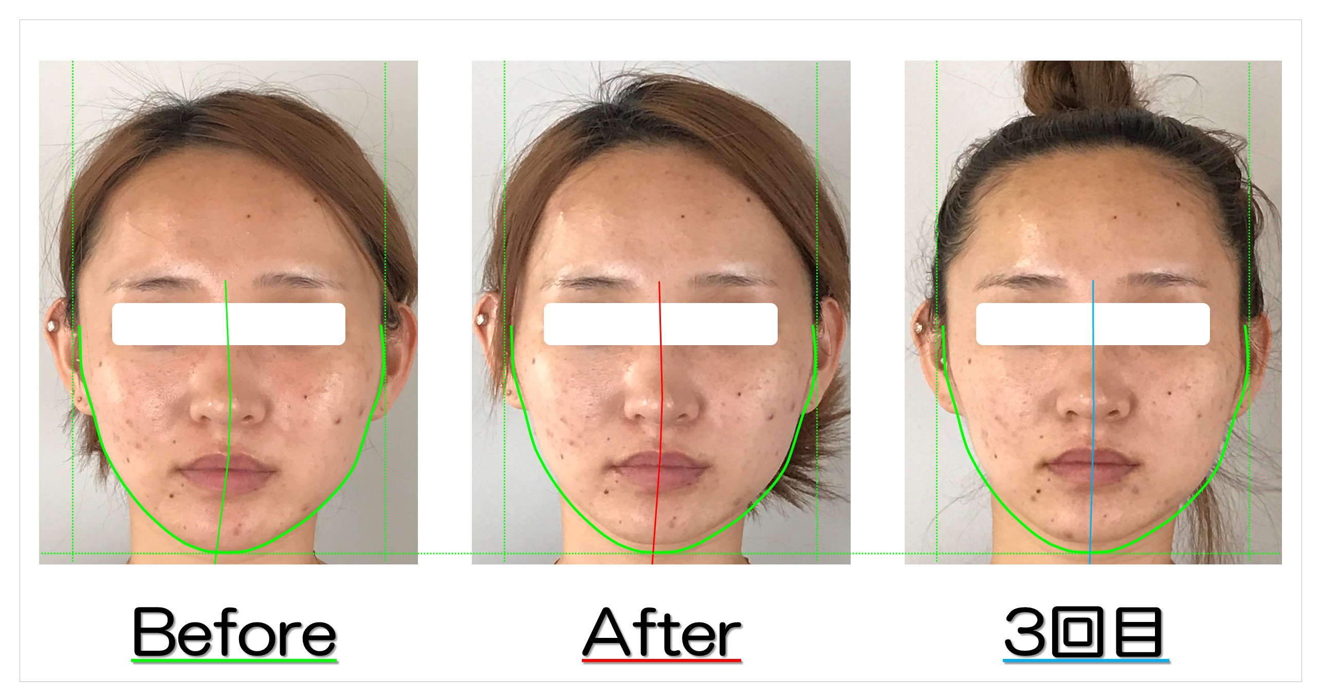 頬の広がりと左右差が改善 滋賀守山市の小顔歪み
