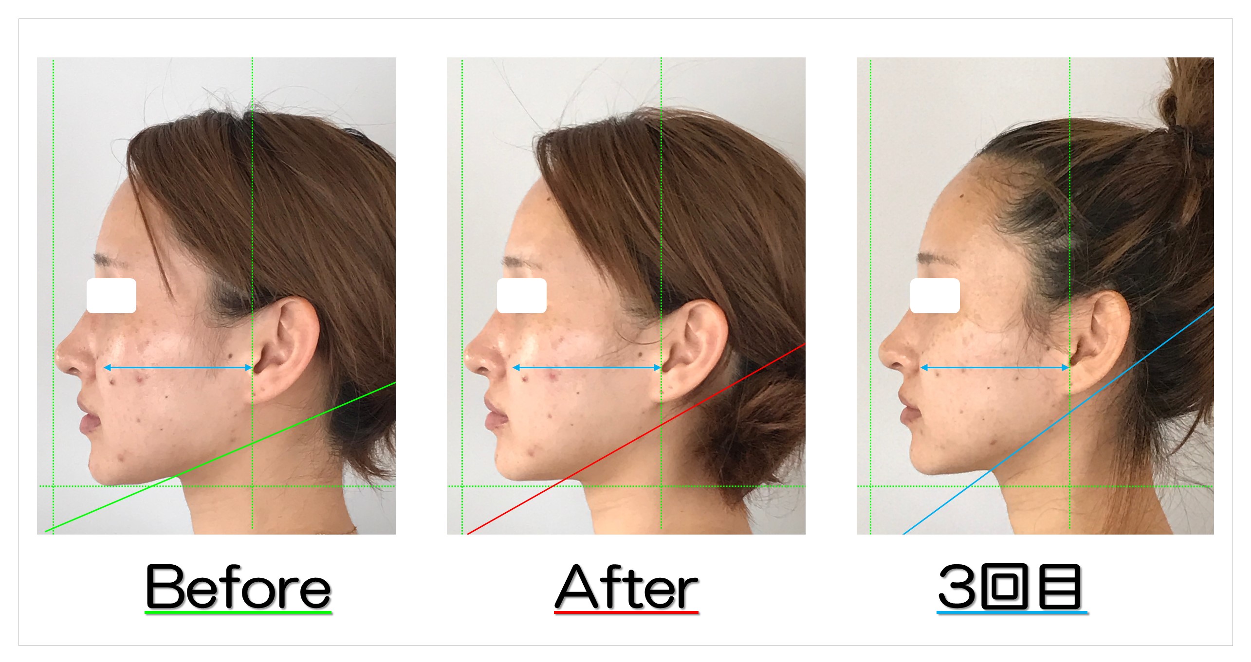 頬の広がりと左右差が改善 滋賀守山市の小顔歪み