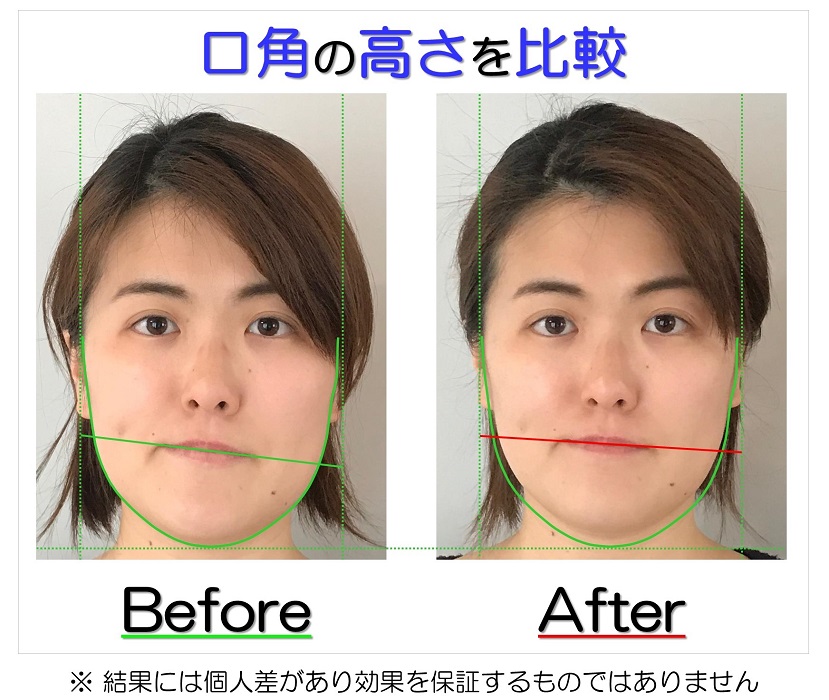 滋賀県守山市の小顔矯正エステ プリュムレーヴ 歪み改善に自信あり