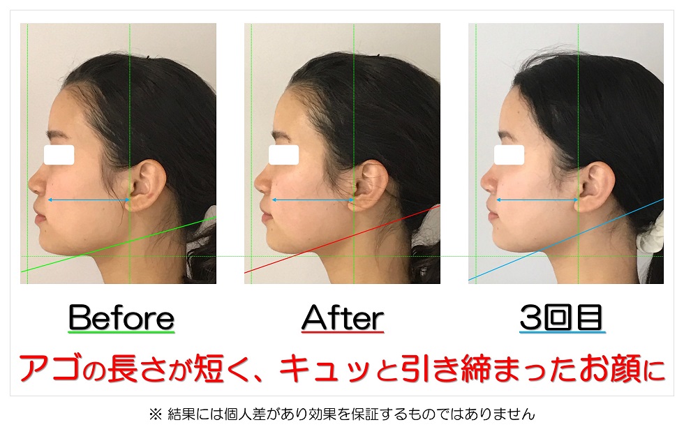 滋賀県守山市の小顔矯正エステ プリュムレーヴ 歪み改善に自信あり
