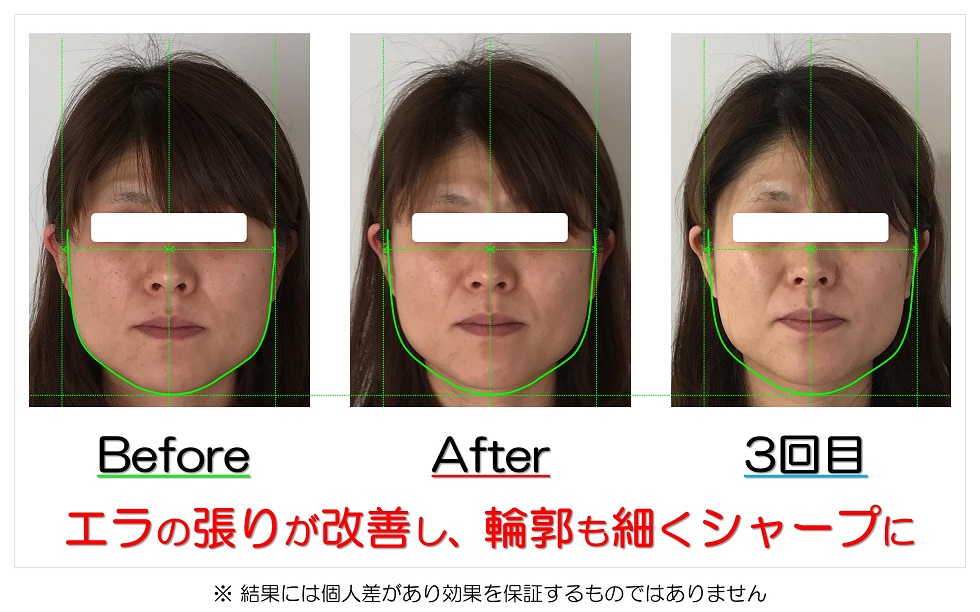 滋賀県守山市の小顔矯正エステ プリュムレーヴ 歪み改善に自信あり