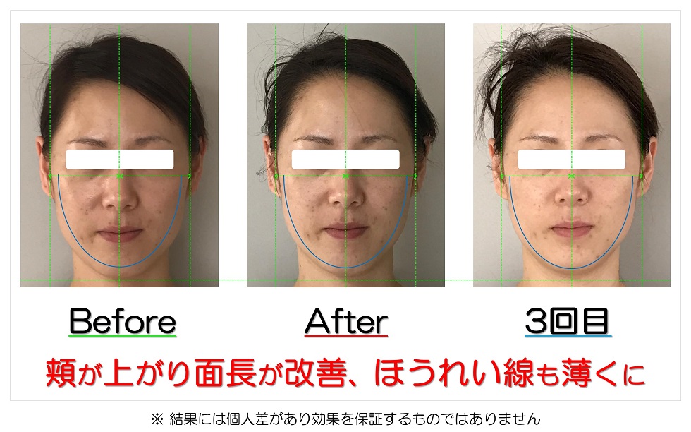 滋賀県守山市の小顔矯正エステ プリュムレーヴ 歪み改善に自信あり