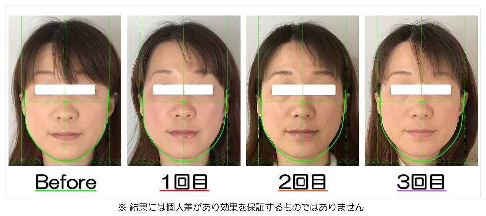小顔矯正エステの内容 滋賀県守山市の小顔矯正エステ プリュムレーヴ