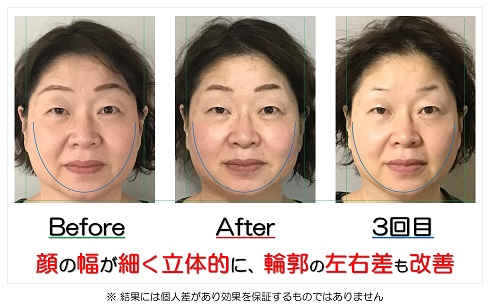 顔の幅が細く立体的に、輪郭の左右差も改善