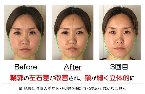 輪郭の左右差が改善され顔が細く立体的に | 滋賀県守山市の小顔矯正エステ プリュムレーヴ