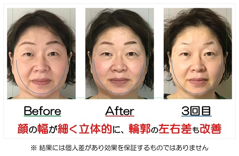 顔の幅が細く立体的に、輪郭の左右差も改善