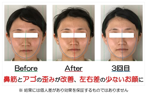 鼻筋とアゴの歪みが改善、左右差の少ないお顔に | 滋賀県守山市の小顔矯正エステ プリュムレーヴ