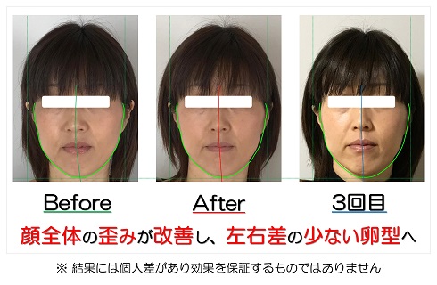 顔全体の歪みが改善し、左右差の少ない卵型へ | 滋賀県守山市の小顔矯正エステ プリュムレーヴ