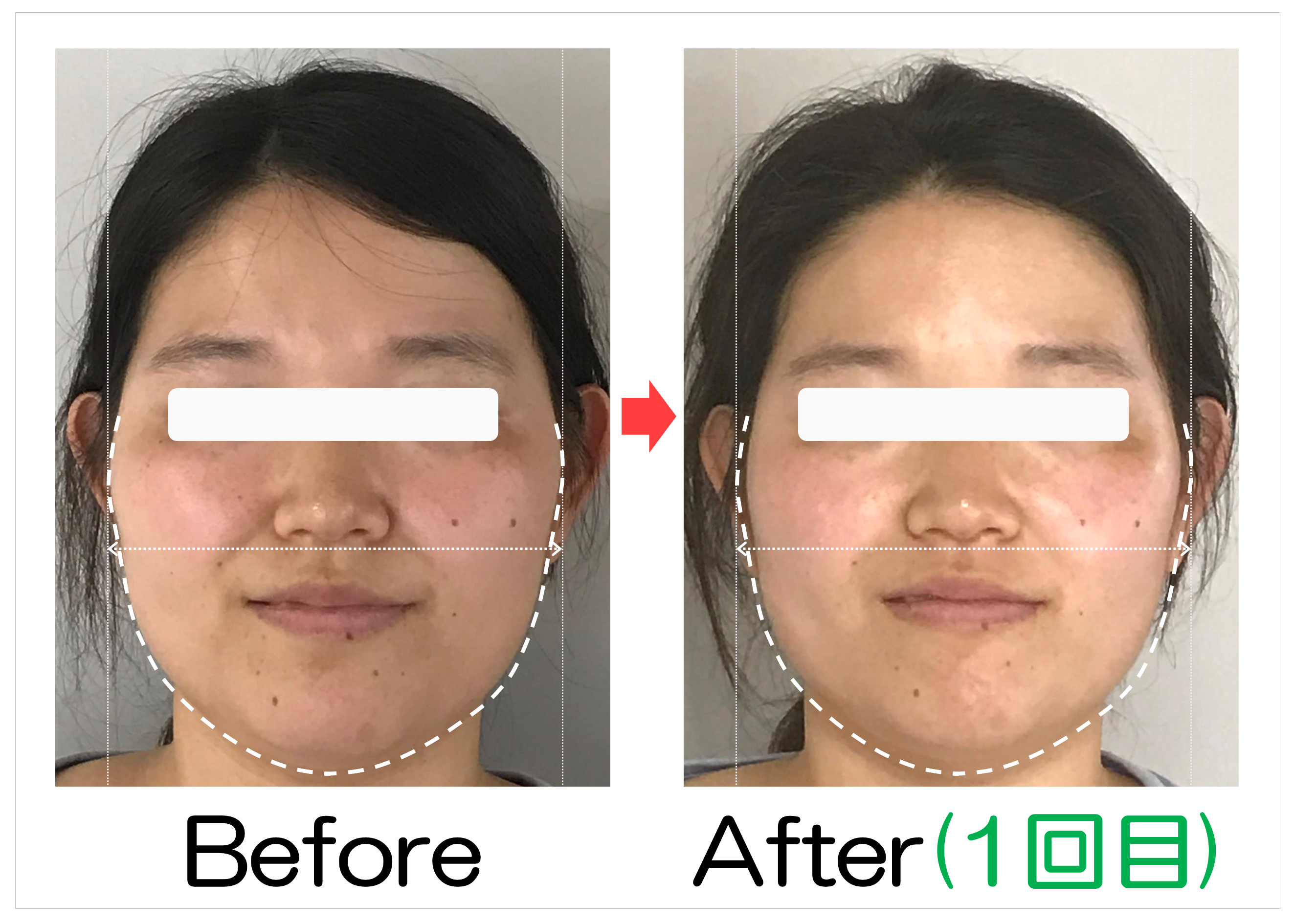 頬からあごの輪郭と卵型ラインのBefore・After(1回目)比較