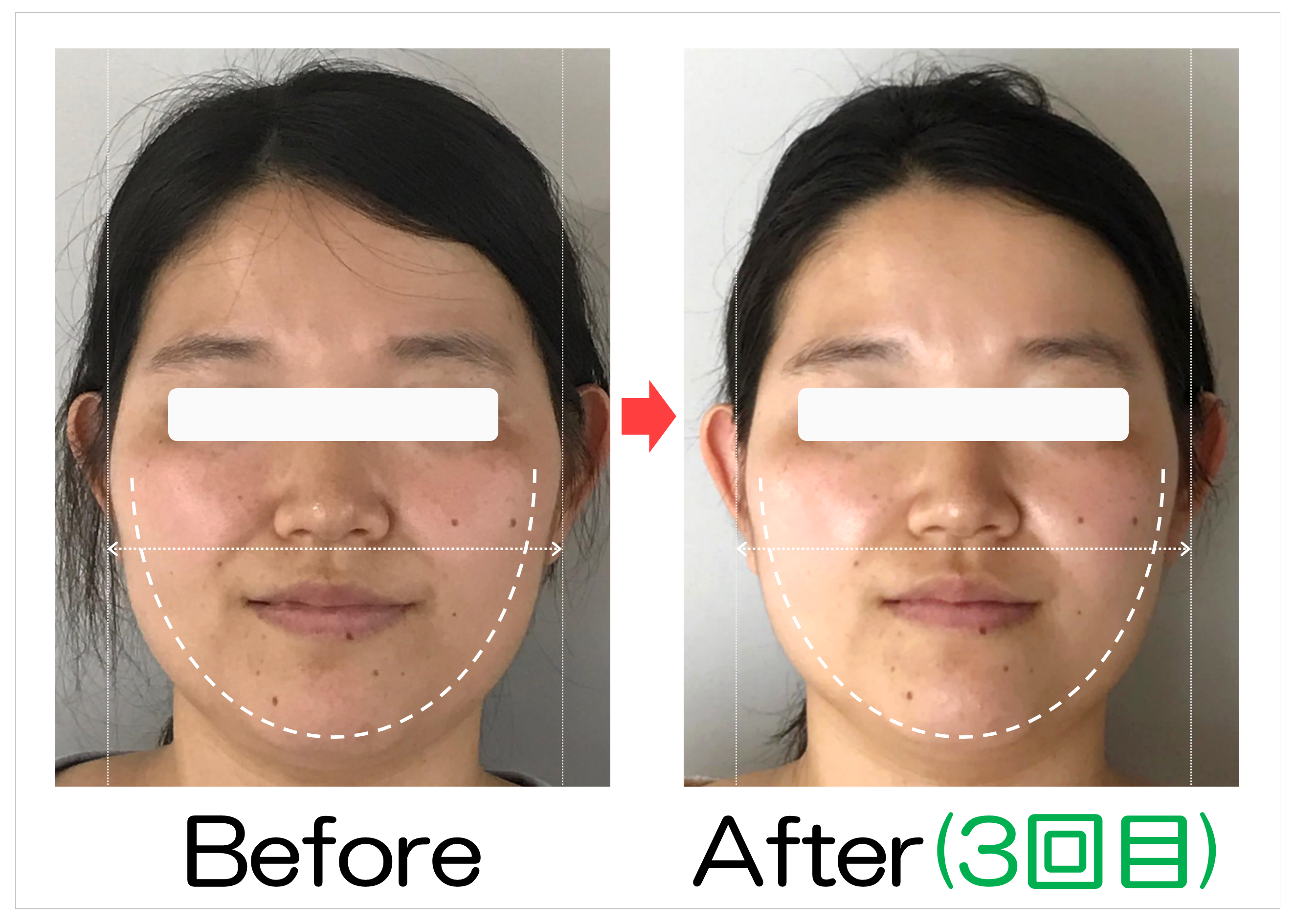 顔の広がりとフェイスラインのBefore・After(3回目)比較