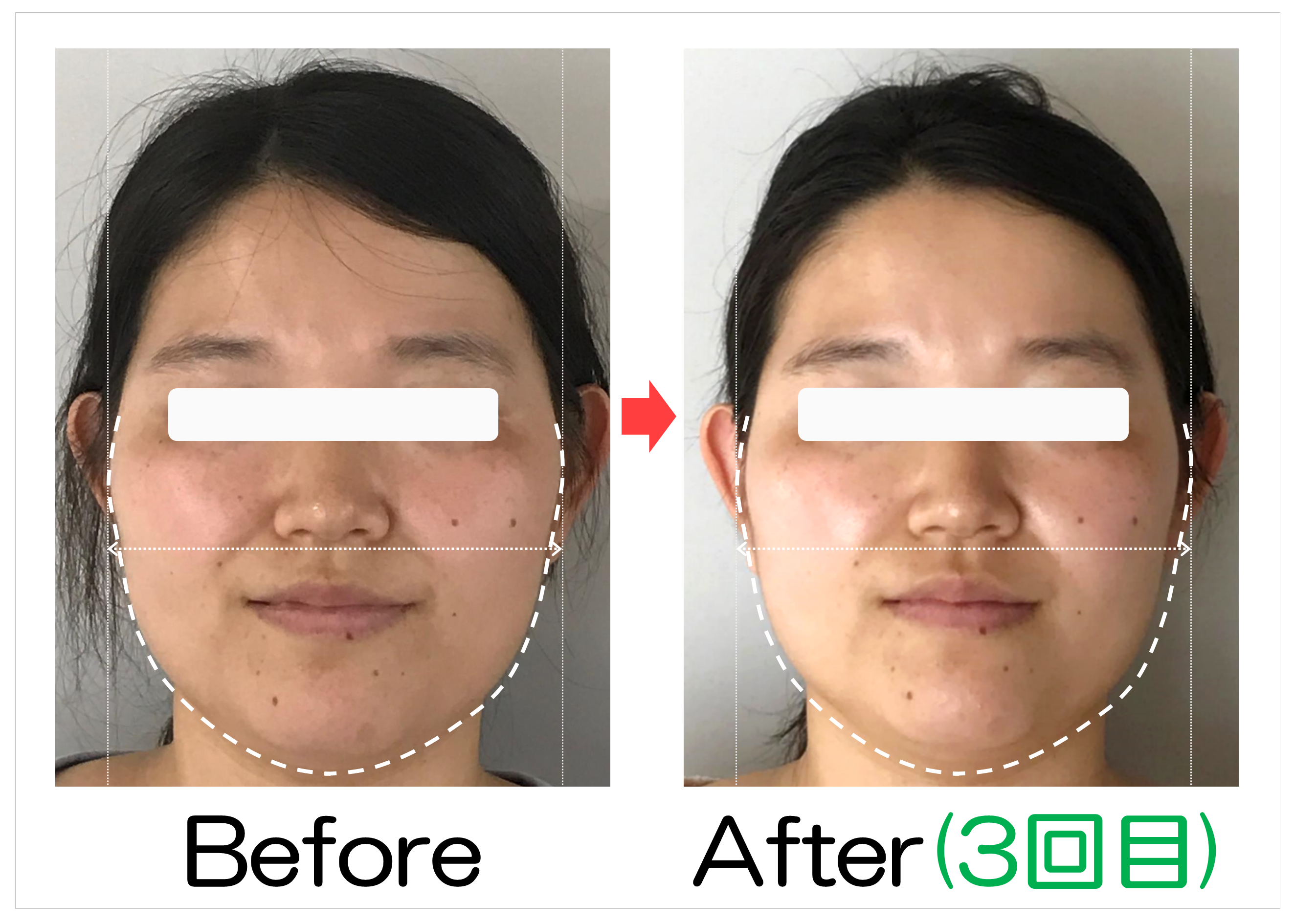 頬からあごの輪郭と卵型ラインのBefore・After(3回目)比較