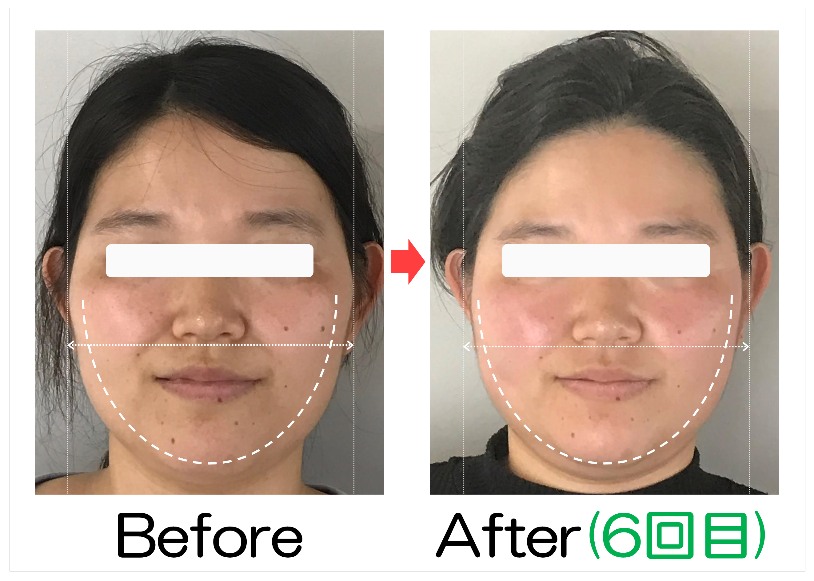 顔の広がりとフェイスラインのBefore・After(6回目)比較