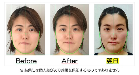 小顔になった変化が視覚的にも実感できるビフォーアフターの比較写真のサービス付き | 滋賀県守山市の小顔矯正エステ プリュムレーヴ