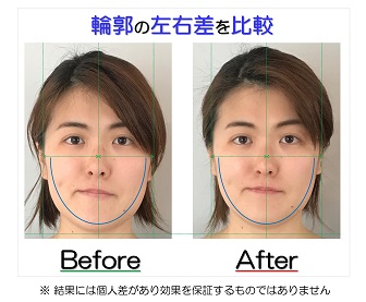 小顔になった変化が視覚的にも実感できるビフォーアフターの比較写真のサービス付き | 滋賀県守山市の小顔矯正エステ プリュムレーヴ