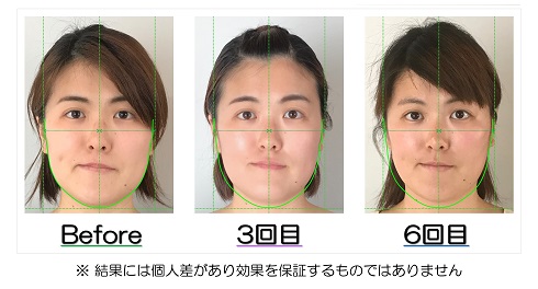 小顔になった変化が視覚的にも実感できるビフォーアフターの比較写真のサービス付き 滋賀県守山市の小顔矯正エステ プリュムレーヴ