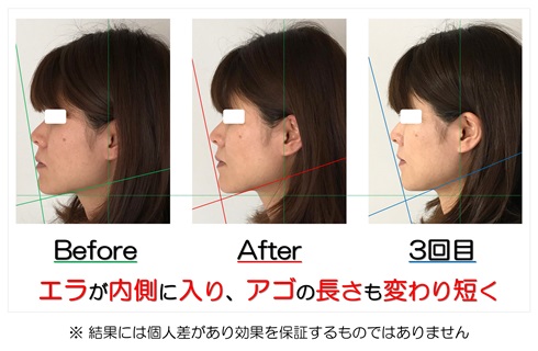 エラが内側に入り、アゴの長さも変わり短く