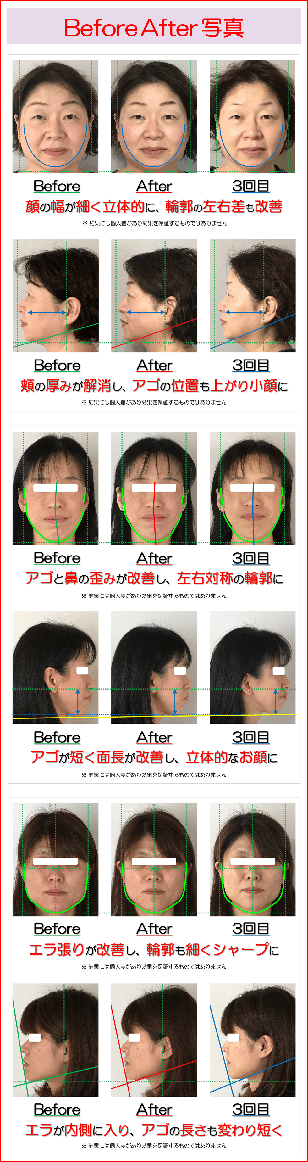 滋賀県守山市の小顔矯正&オーガニックハーブティーの店 若返り専門サロン プリュムレーヴ | Before After 写真