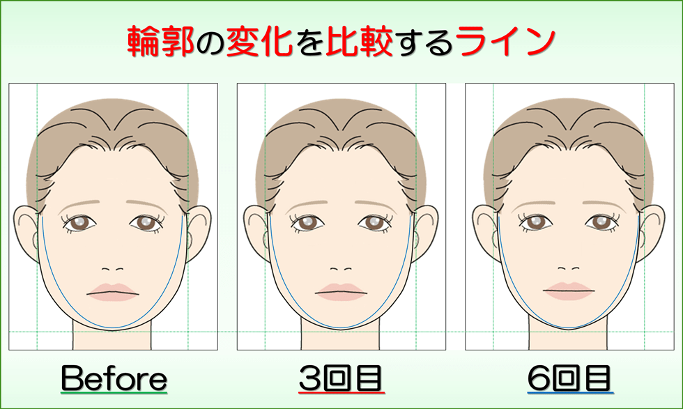 小顔になった変化が視覚的にも実感できるビフォーアフターの比較写真のサービス付き 滋賀県守山市の小顔矯正エステ プリュムレーヴ