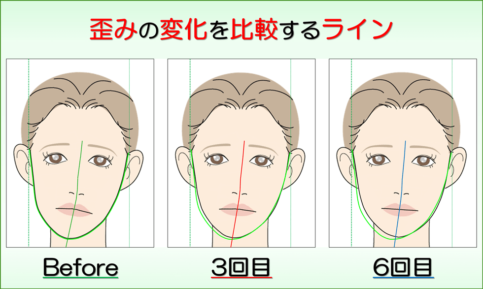 小顔になった変化が視覚的にも実感できるビフォーアフターの比較写真のサービス付き 滋賀県守山市の小顔矯正エステ プリュムレーヴ