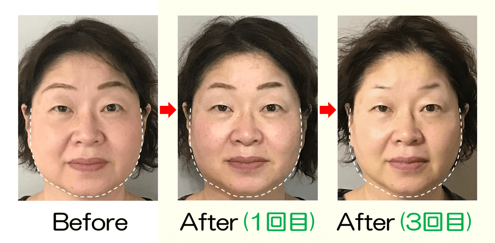 滋賀 小顔矯正｜輪郭の左右差が改善したビフォーアフター比較写真（Before・After・3回目）