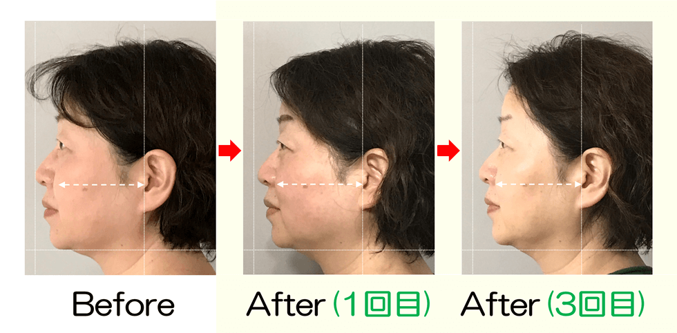 横顔の厚みがすっきりリフトアップしたビフォーアフター比較写真｜滋賀 小顔矯正