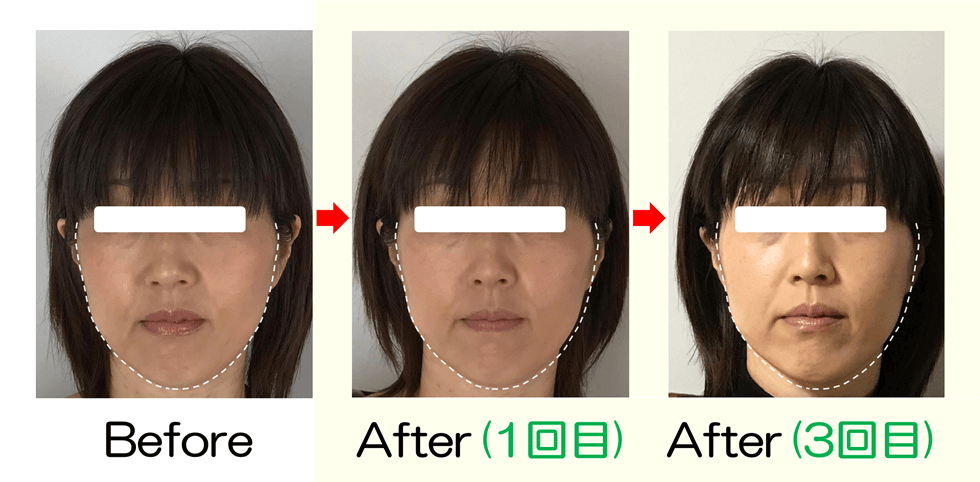 長年の顔の歪みと長さが改善! | 滋賀守山市の小顔矯正サロン プリュムレーブ