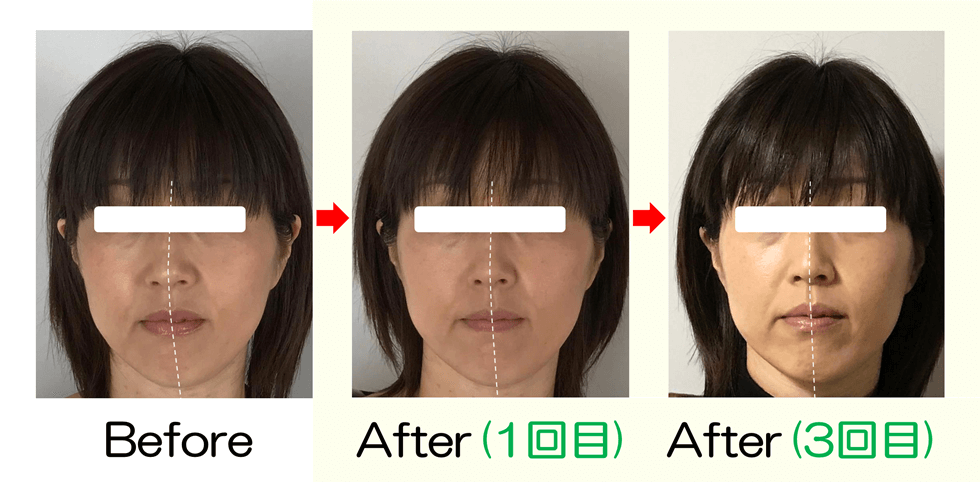 長年の顔の歪みと長さが改善! | 滋賀守山市の小顔矯正サロン プリュムレーブ