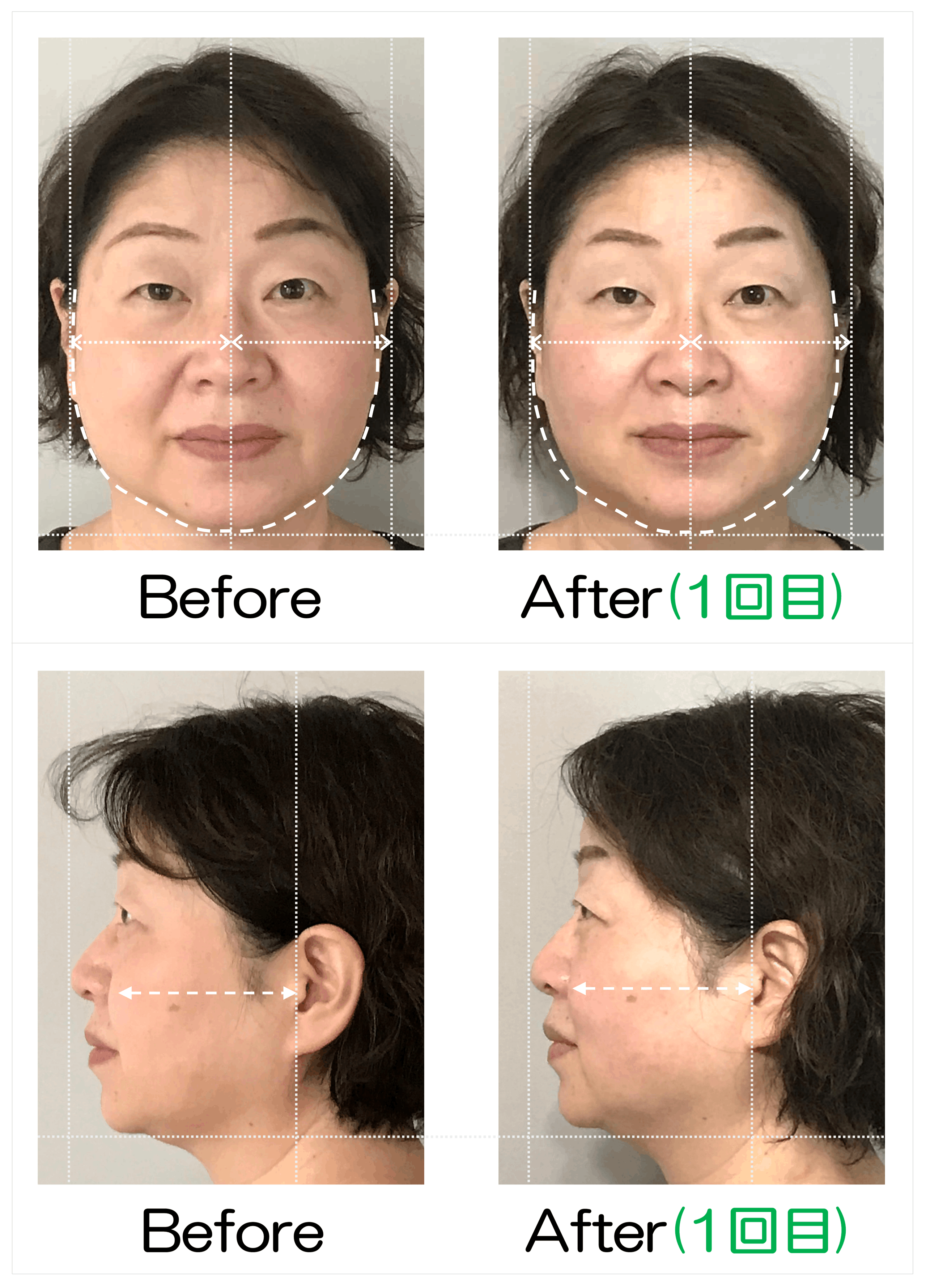 小顔矯正のBeforeとAfter（1回目）の比較写真。上段は正面、下段は横顔