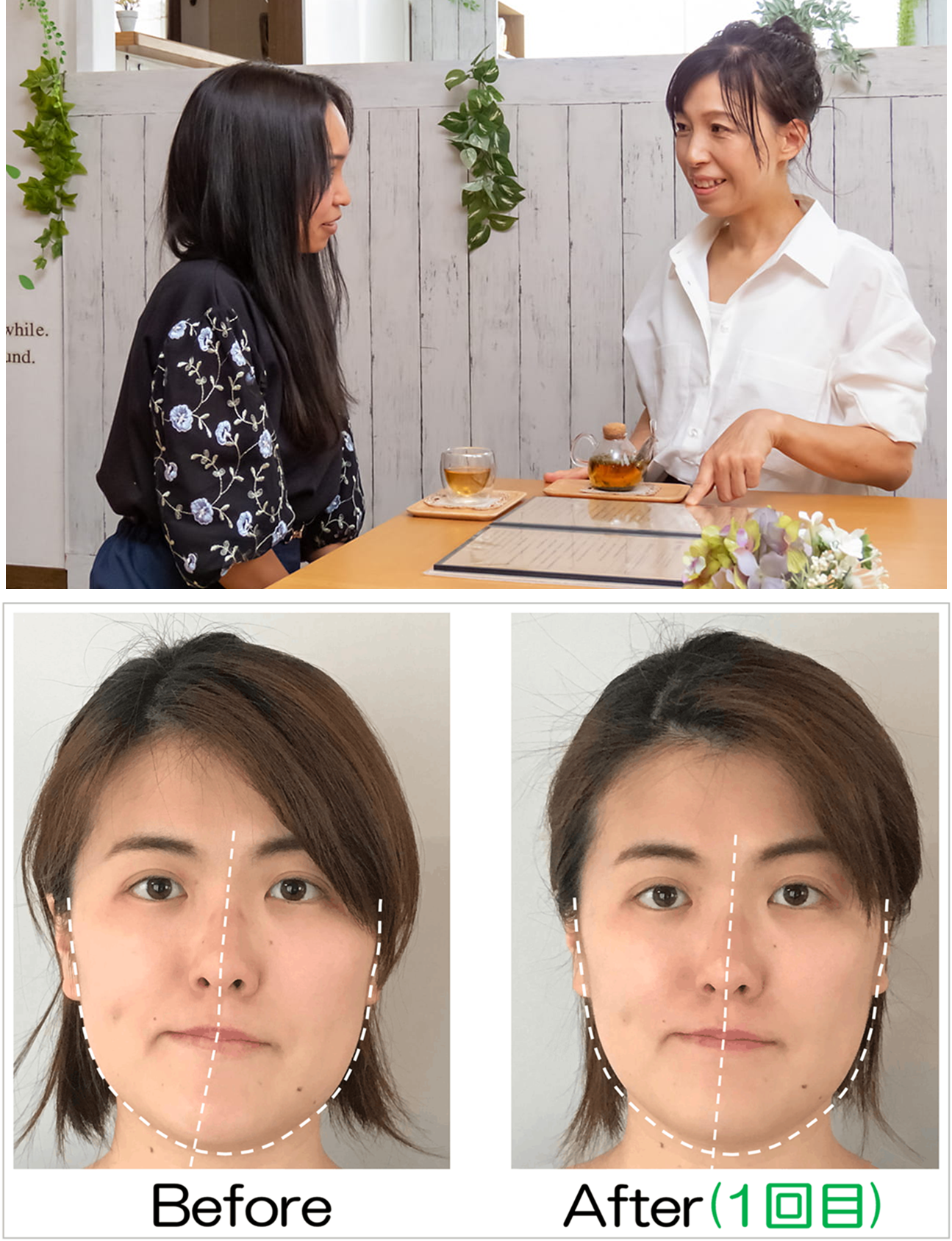 施術後のアフターカウンセリングとBeforeAfter写真の確認