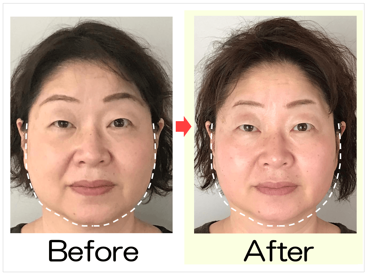 プリュムレーヴの小顔矯正 Before After