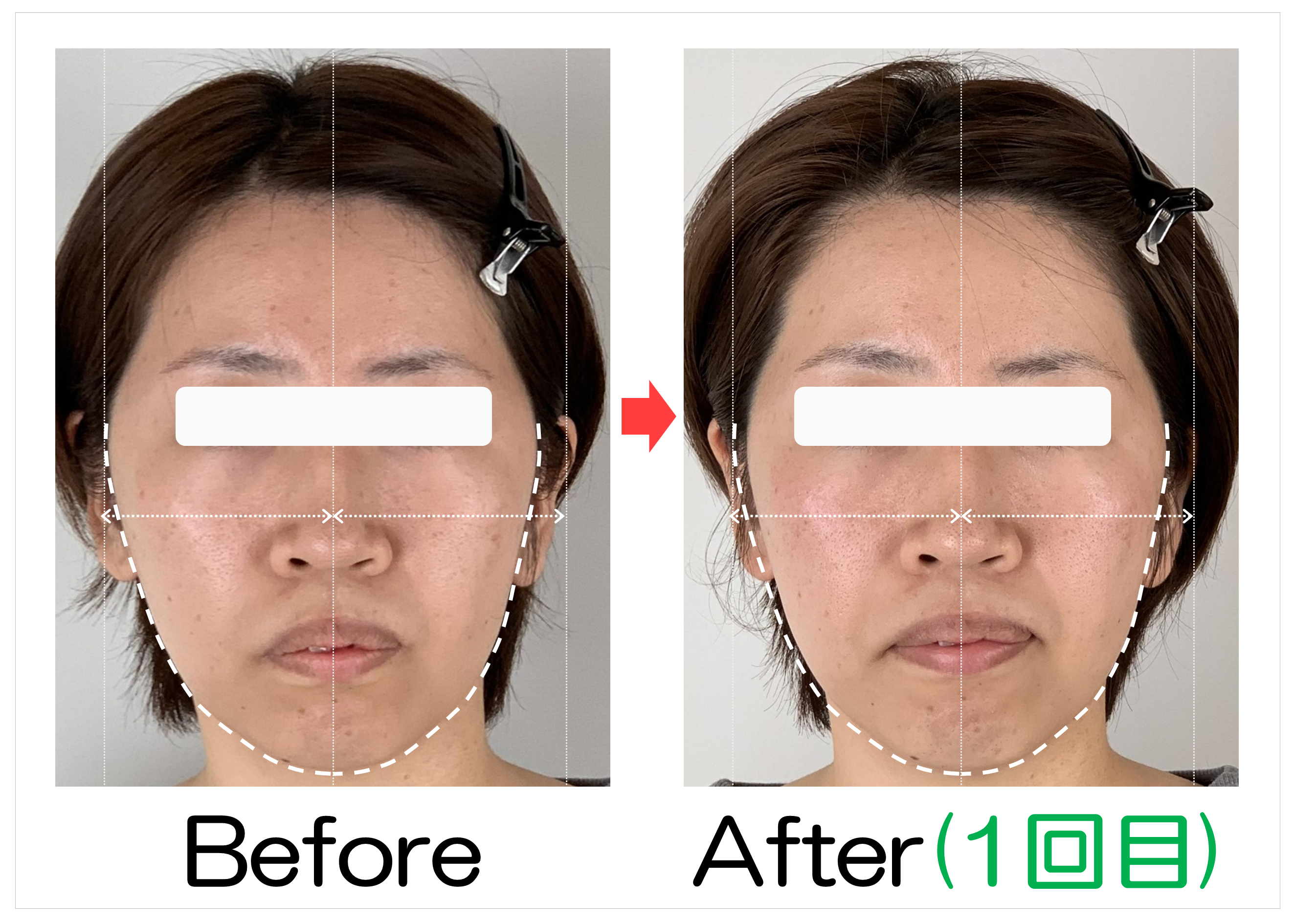 輪郭の左右差とフェイスラインのBefore・After(1回目)比較