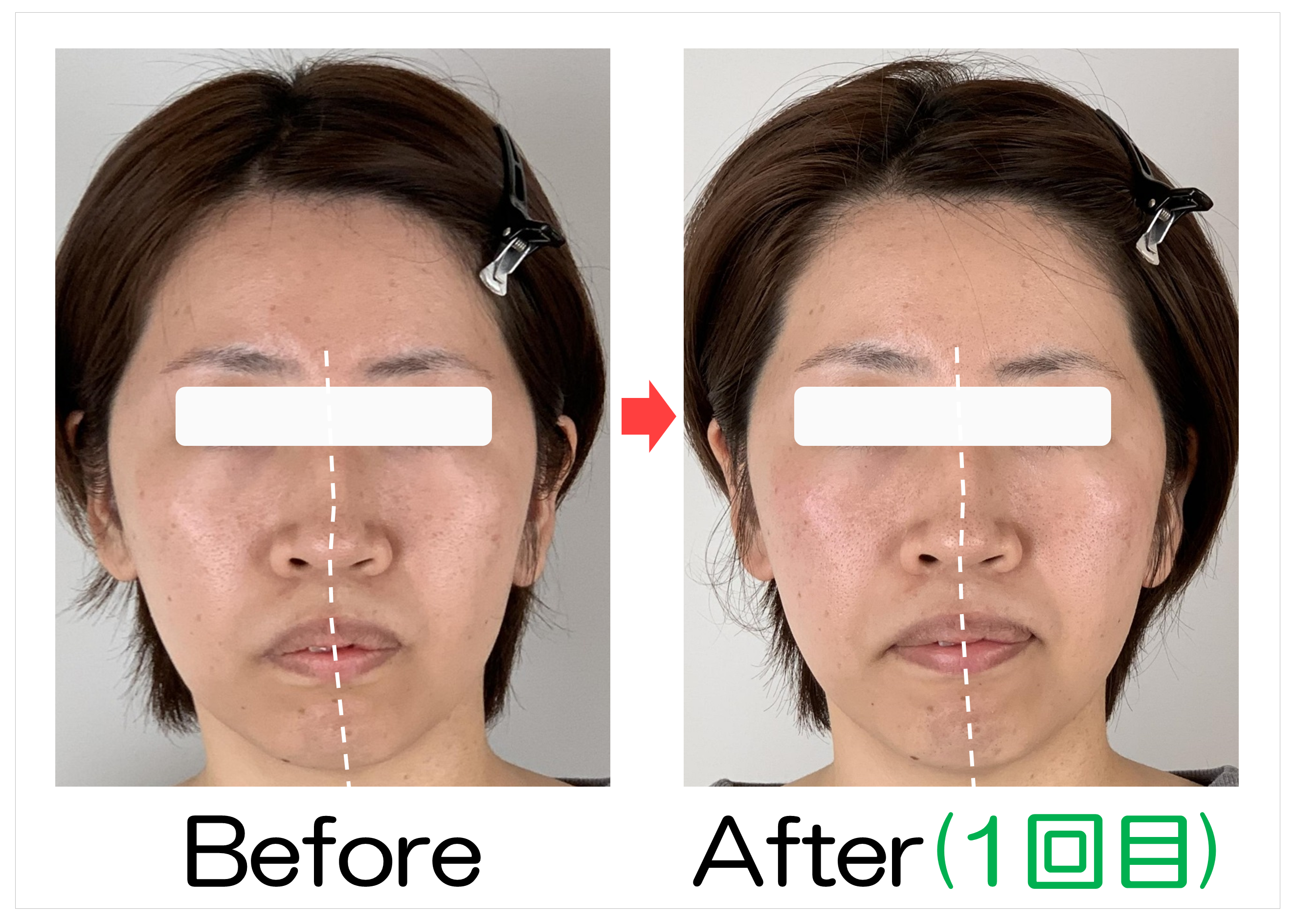鼻筋からあごの位置のBefore・After(1回目)比較
