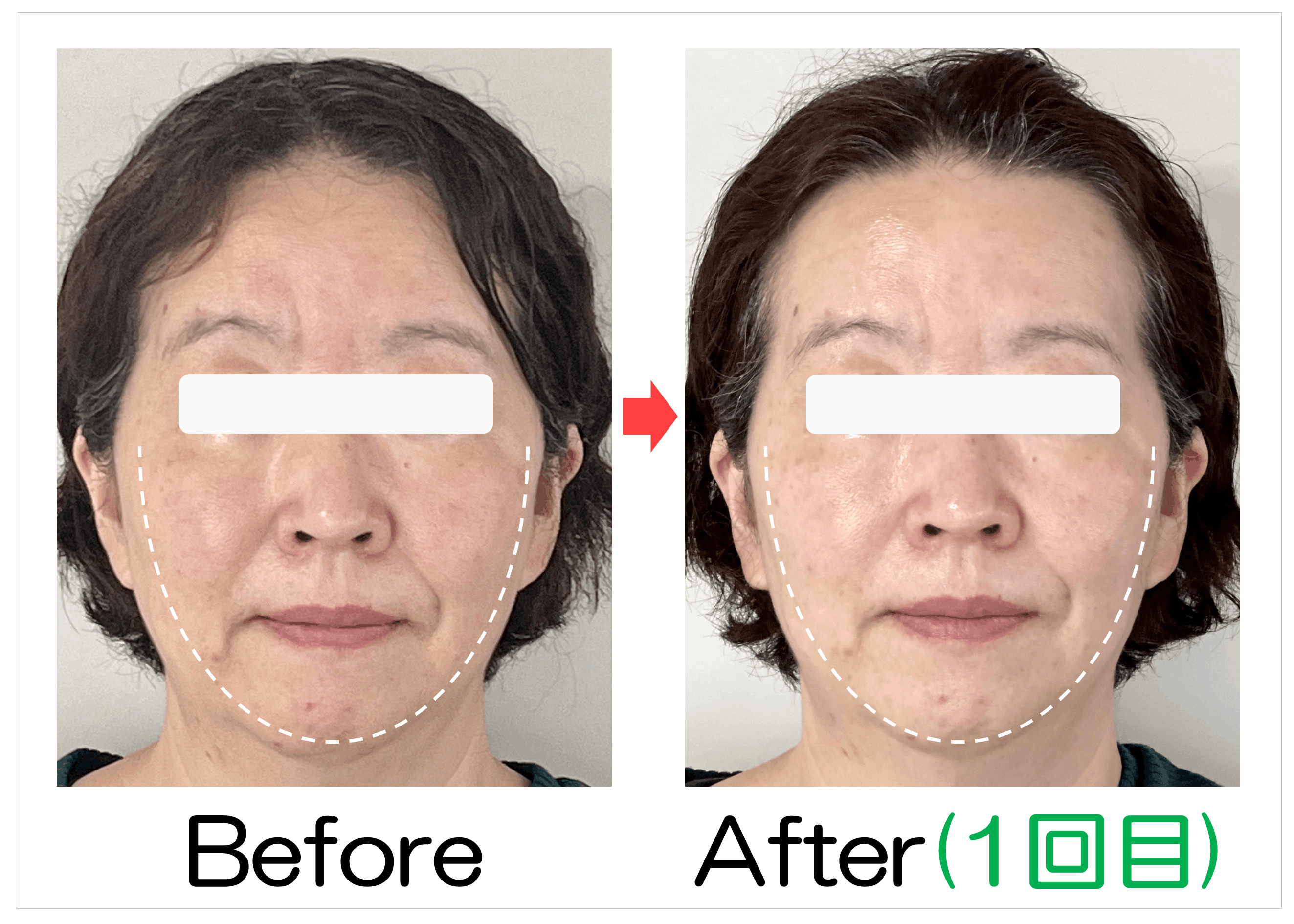 50代女性の卵型ラインBefore・After(1回目)比較