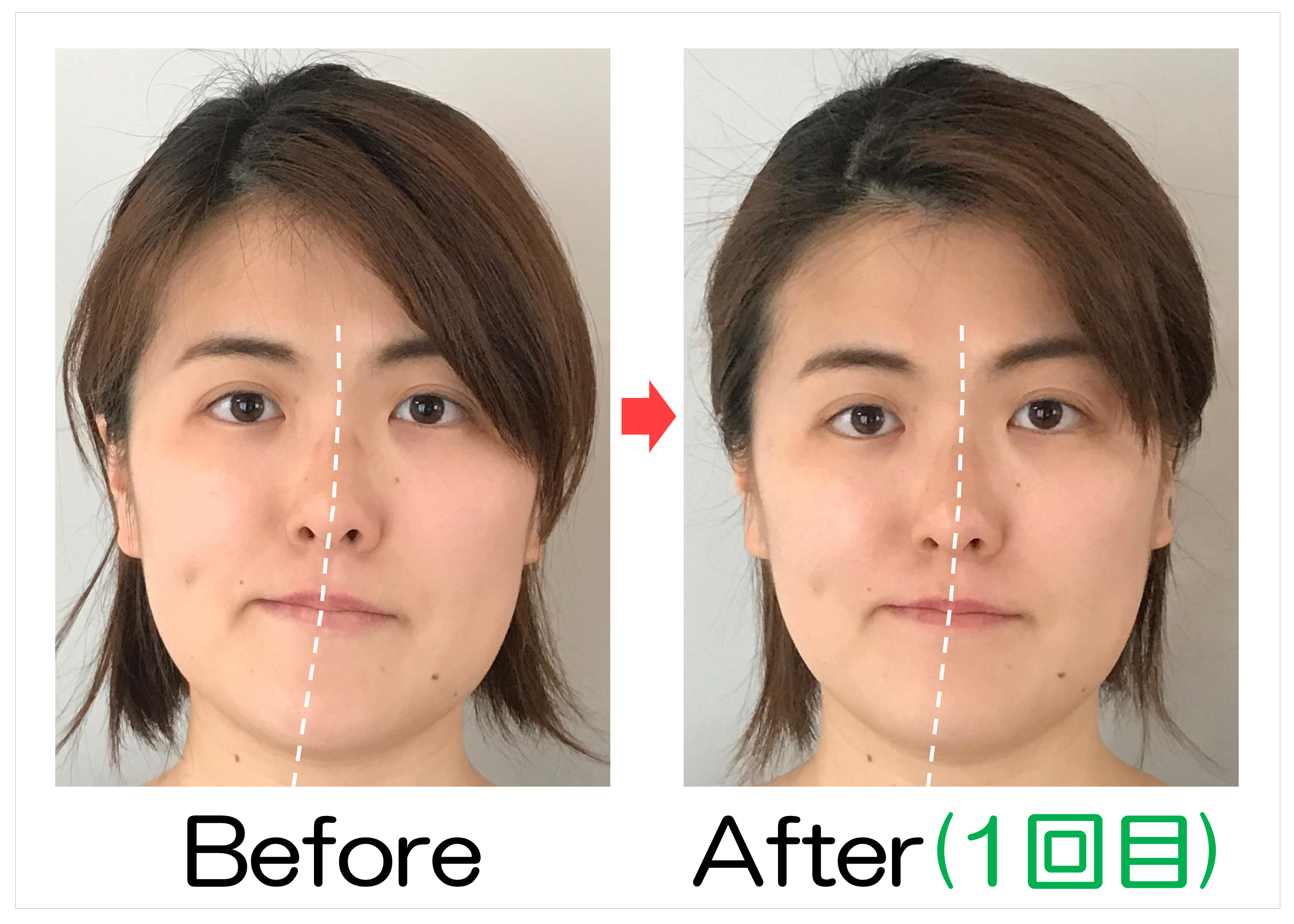 鼻筋からあごの位置のBefore・After(1回目)比較