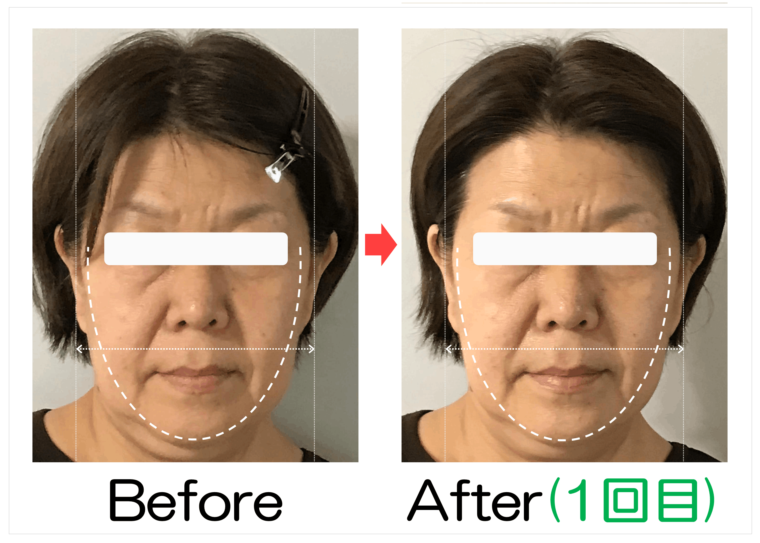 卵型ラインと輪郭のBefore・After(1回目)比較