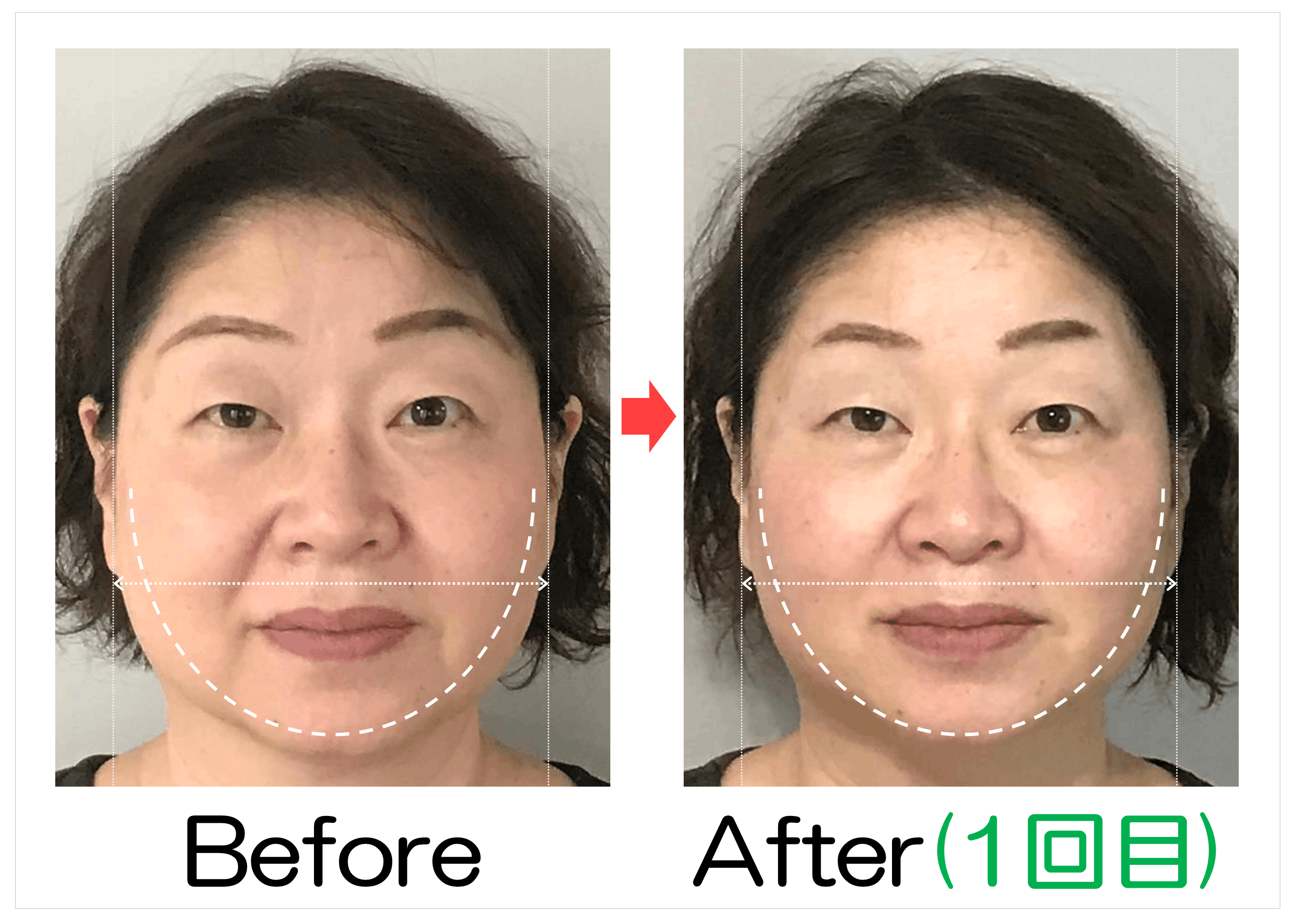 頬からあごの輪郭と卵型ラインのBefore・After(1回目)比較