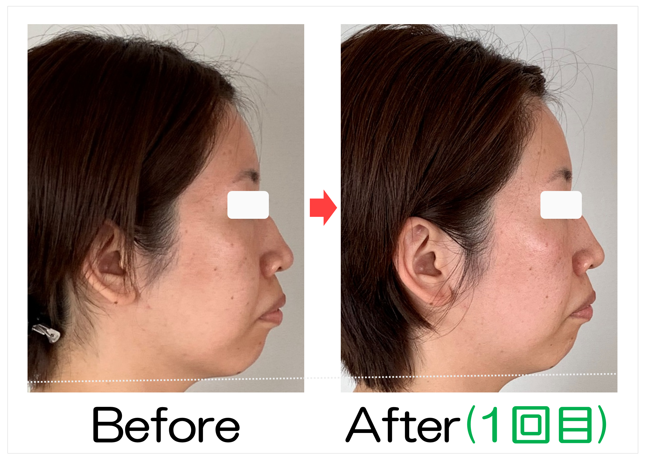 頬からあごの横顔のBefore・After(1回目)比較