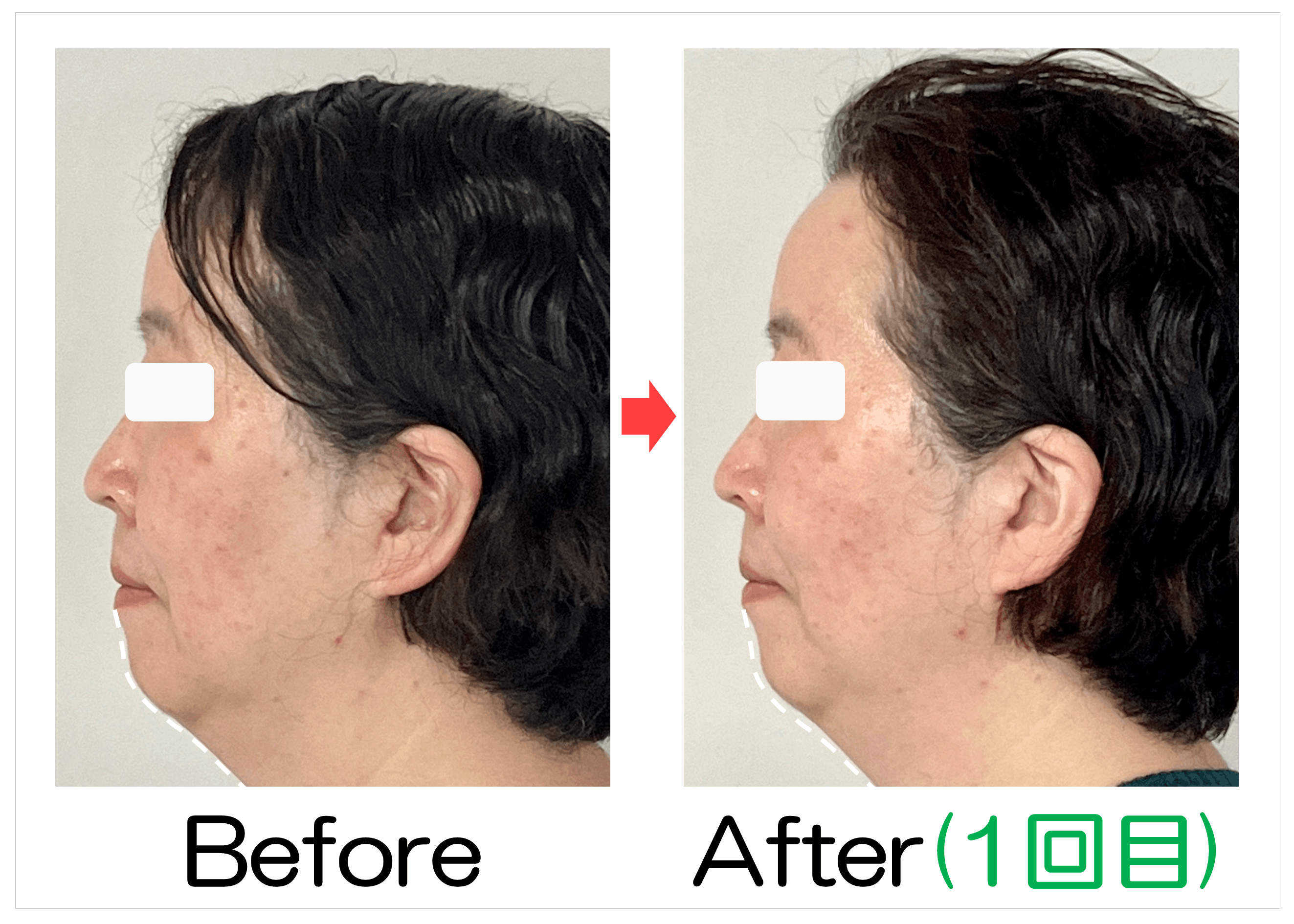 50代女性のあご下と横顔Before・After(1回目)比較