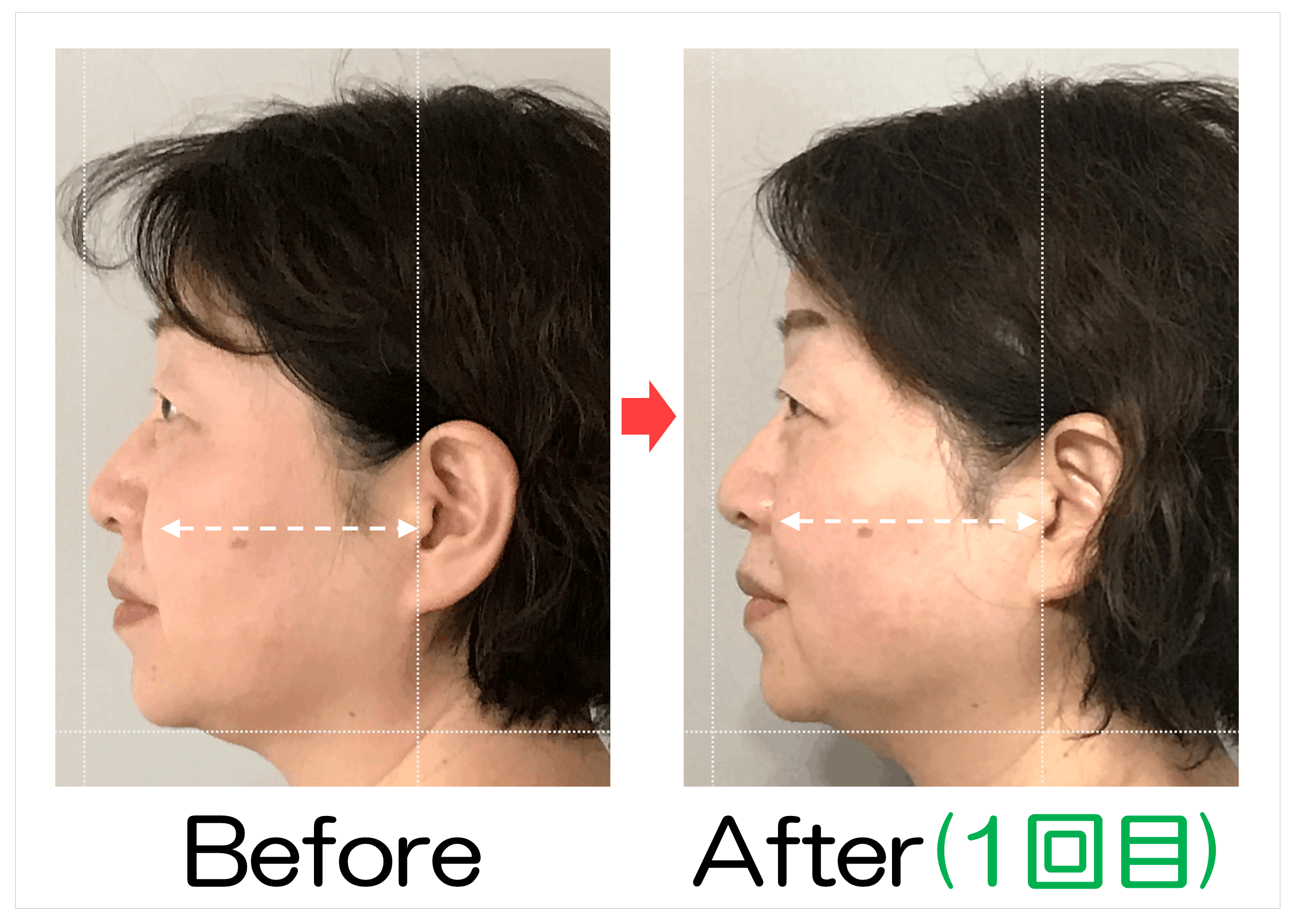 頬の厚みと横顔のBefore・After(1回目)比較