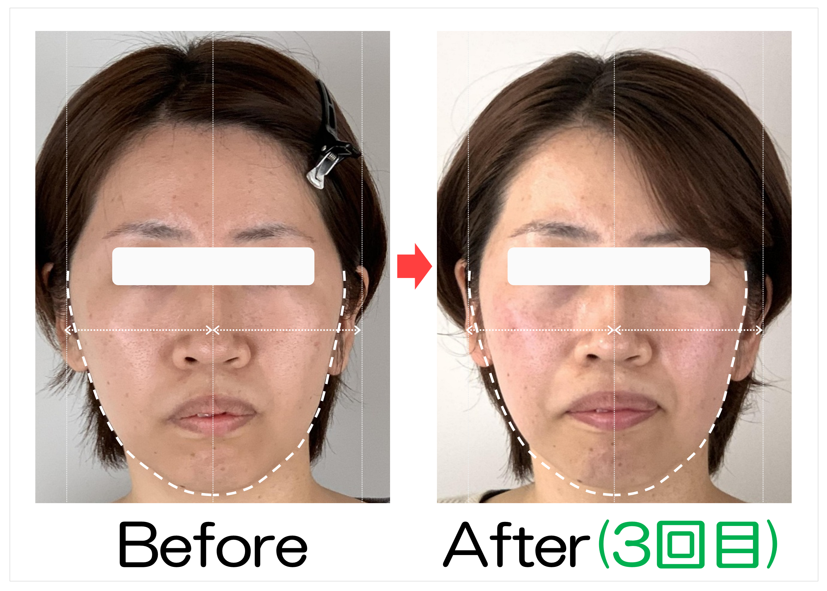 輪郭の左右差とフェイスラインのBefore・After(3回目)比較